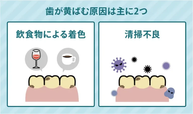 歯が黄ばむ原因